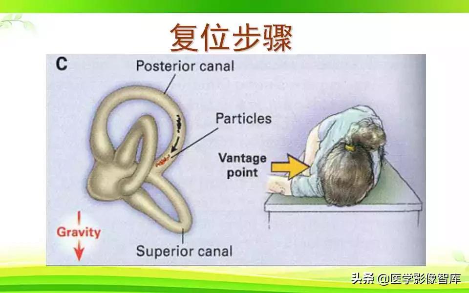 容易被误诊为耳石症的疾病,耳石症眩晕怎么确诊