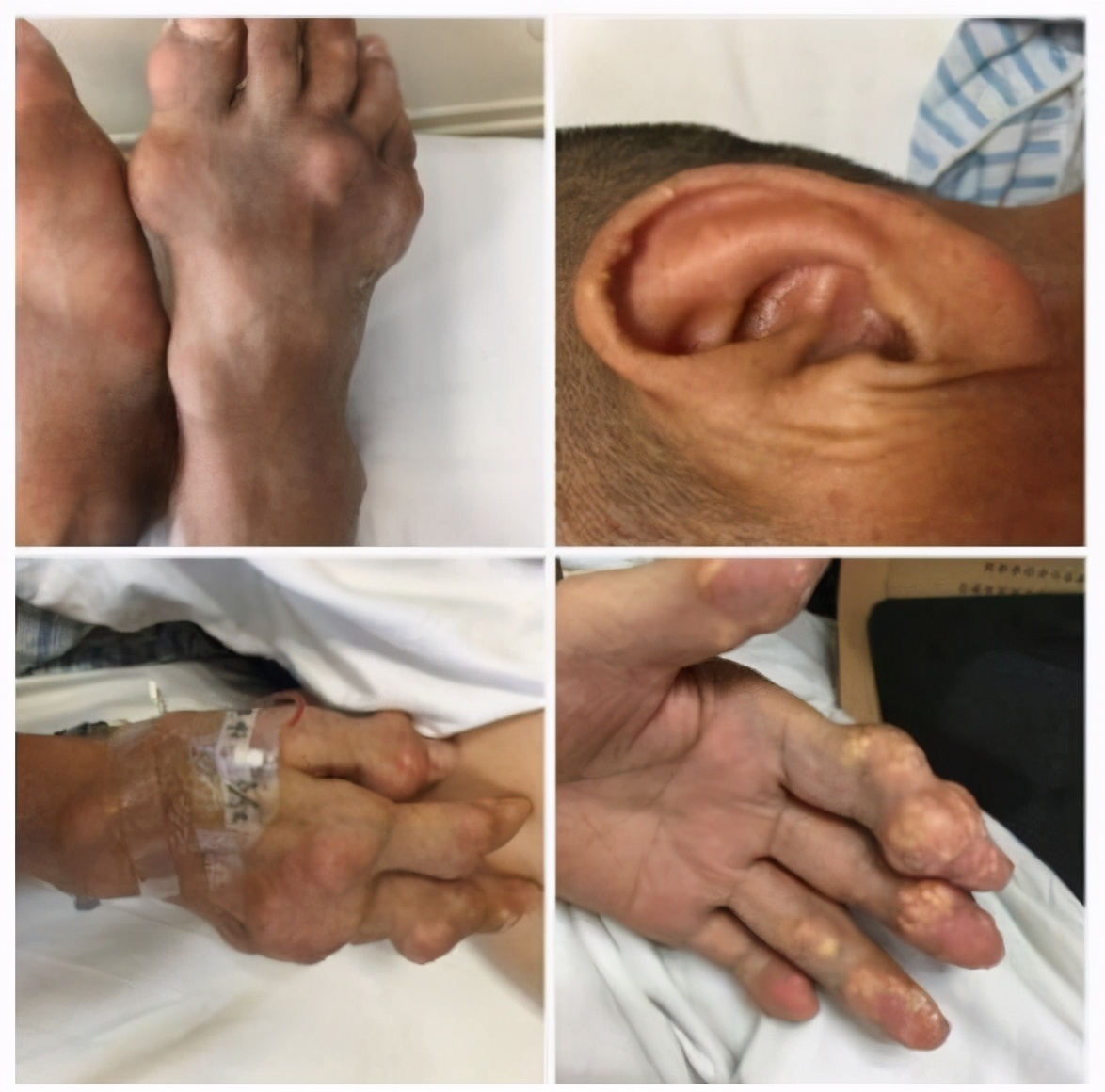 痛风石为什么会自己破,痛风石破了怎么处理