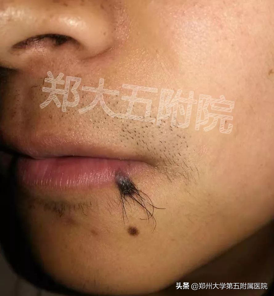 色素痣病理报告,头上色素痣图片