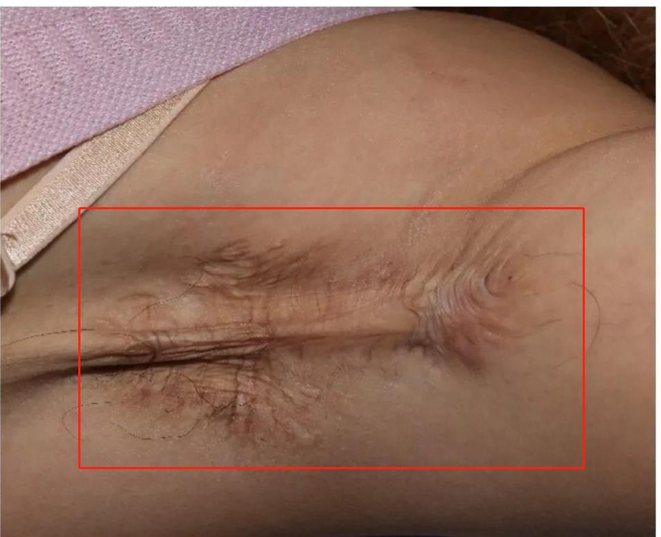 狐臭手术留下的疤痕怎么消除,狐臭手术留下的疤痕又痛又痒