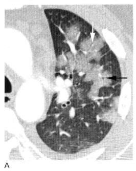 肺实变和肺炎的影像学区别,肺实变图