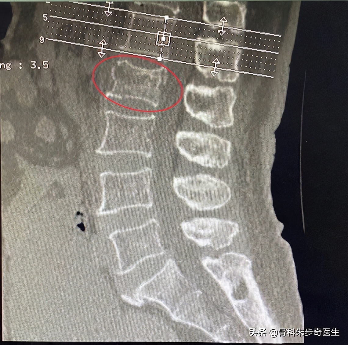 腰椎骨折什么时候能干重活,胸腰椎骨折手术好还是保守治疗好