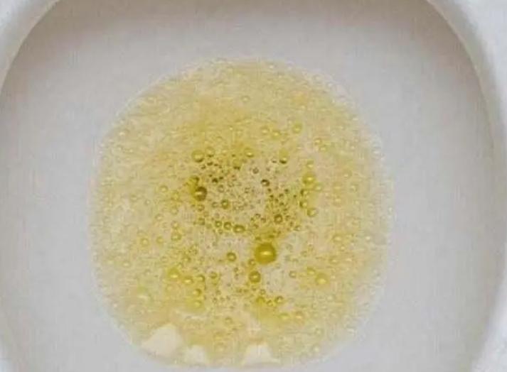 男性上厕所有褐色血是怎么回事,男性尿酸高的原因和危害有哪些