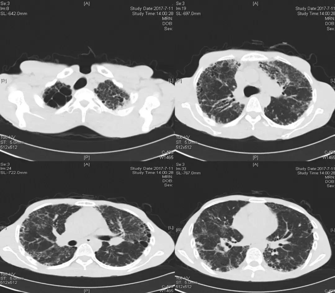 肺纤维化病例,肺纤维化手指甲发紫还能活多久