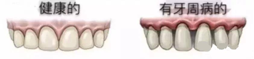 为什么牙龈会萎缩牙齿越来越小,牙龈为何萎缩如何补救
