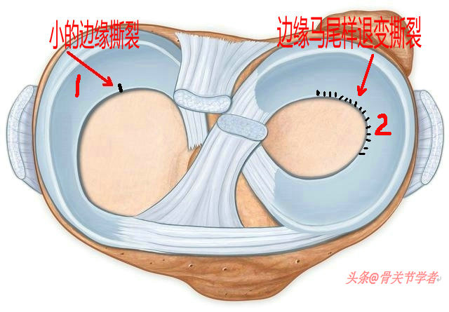 磁共振检查半月板损伤有误诊率吗,半月板磁共振会不会有误诊