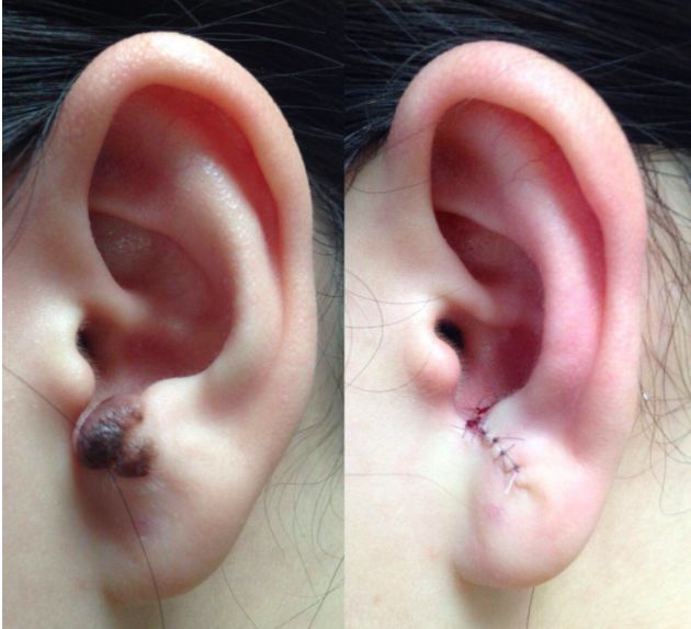 起痣是用药好还是用激光好,点长毛的痣需要手术还是激光