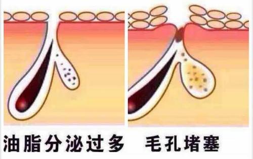 额头密密麻麻的小点点怎么去除,额头上凸起的小疙瘩怎么去除