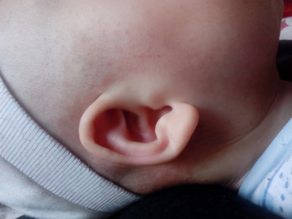 抗生素预防性用药,莱姆病抗生素治疗在哪一时期有效