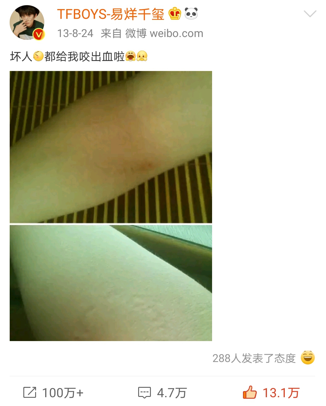 杨幂拍戏被蚊子叮满包？易烊千玺被咬出血？明星们怎么强效驱蚊？