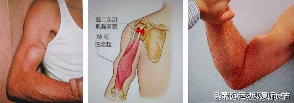 肌肉拉伤后怎样运动康复,肌肉拉伤如何运动恢复