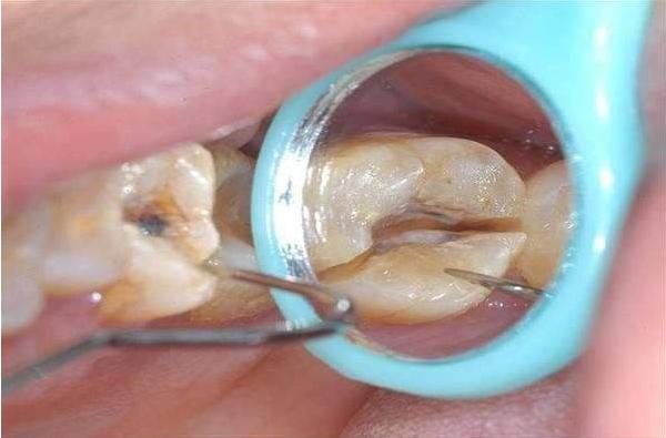 根管治疗是牙的什么问题,根管治疗真的是无法承受之痛吗