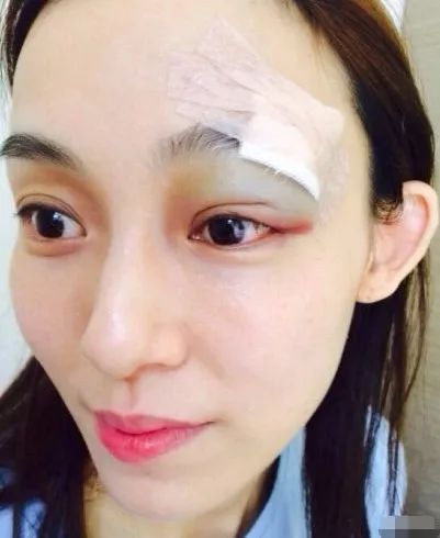 范玮琪摔跤反被疑怀孕，下巴皮开肉绽缝15针，还被骂炒作现世报