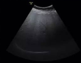 脂肪肝的防治与调养,脂肪肝的防治食物