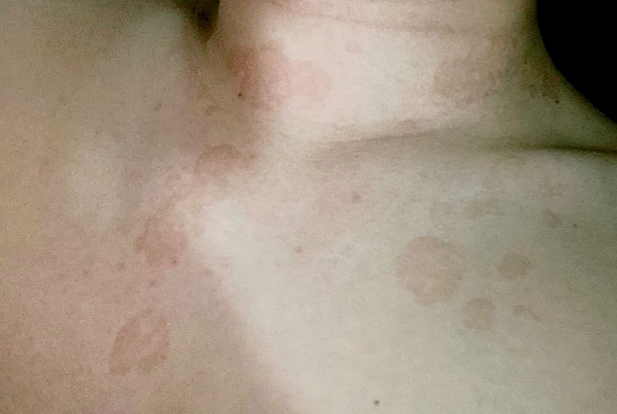 汗斑怎么去除才能彻底根治,背上有汗斑怎么样才能根治