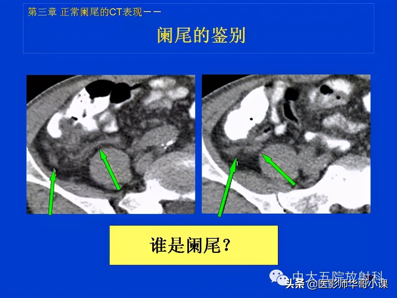 阑尾炎课件,阑尾炎的超声课件