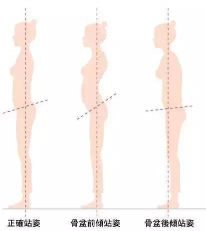 骨盆前倾对身体有什么影响,骨盆前倾最好的解决方法
