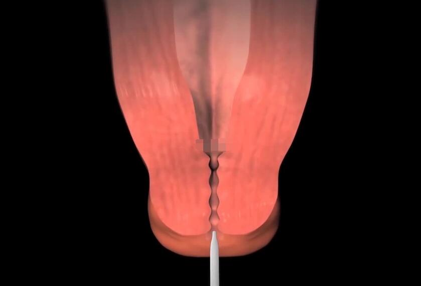 人流手术多久可以跳舞,人流9天可以去蹦迪吗