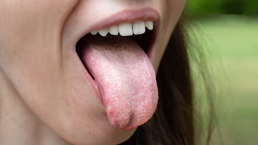 嘴巴上有小白点是怎么回事,有口腔白斑刷牙出血