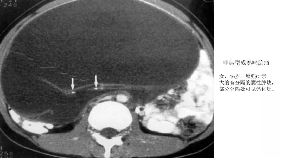 卵巢原发肿瘤的分析思路