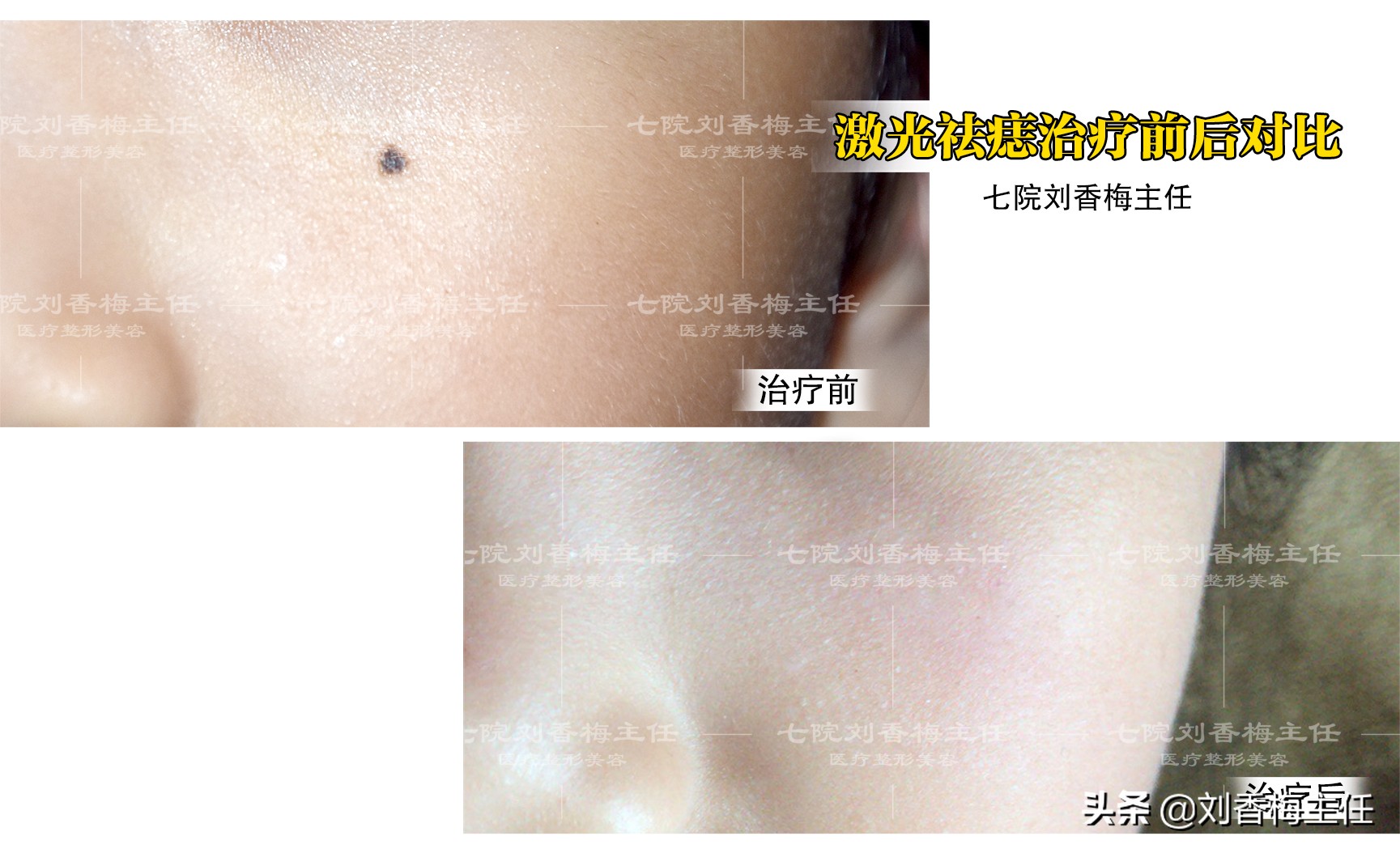 黑痣要弄掉看什么科,黑痣去除是看外科还是皮肤科