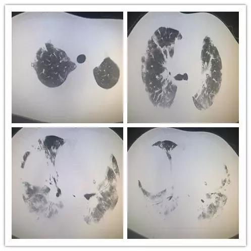 呼吸困难为主要症状的住院大病历,病人出现呼吸困难症状
