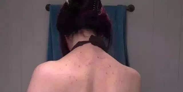 强力鸡皮皂,鸡皮肤救星正品