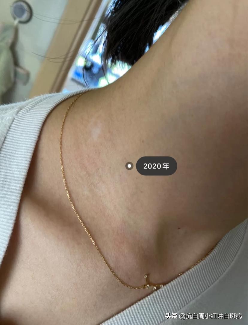 白癜风患者治好的全过程,白癜风治愈患者分享痊愈经验