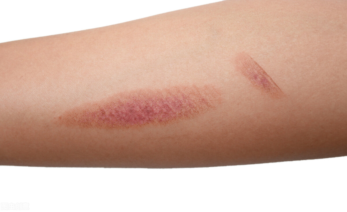 烧伤的伤疤要怎么去除,烧伤的疤痕怎么能彻底消除