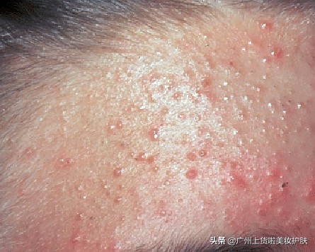 得了激素过敏性皮炎怎么办,得了激素性皮炎记住一停二忍三调