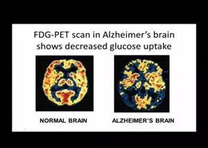 量化椰子油，在保持心血管健康和预防阿尔兹海默症之间找到平衡点