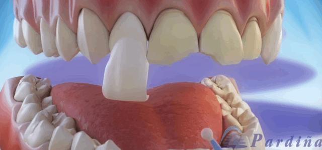 烤瓷牙贴片全口价格,贴片牙齿和烤瓷牙有哪些伤害