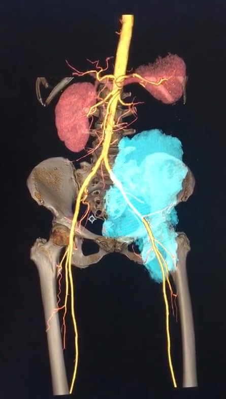 崴脚后意外发现肿瘤，肿瘤门诊故事多，听医生说句心里话