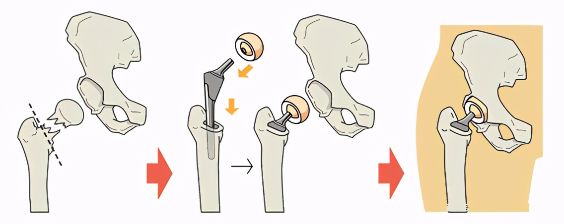 股骨头坏死不手术也能好,股骨头坏死手术多长时间能干重活