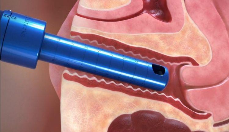 山西首秀！全球最先进的妇科激光治疗仪落户太原中心医院汾东院区