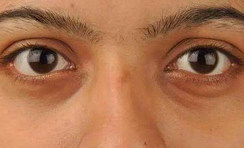 激光祛眼袋适合哪类人,生姜祛眼袋的正确方法