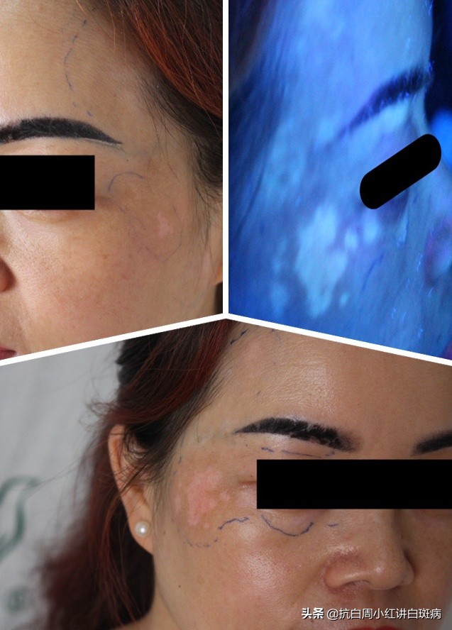 白癜风的白斑一般的症状是什么呢,白癜风的白斑一般的症状是什么