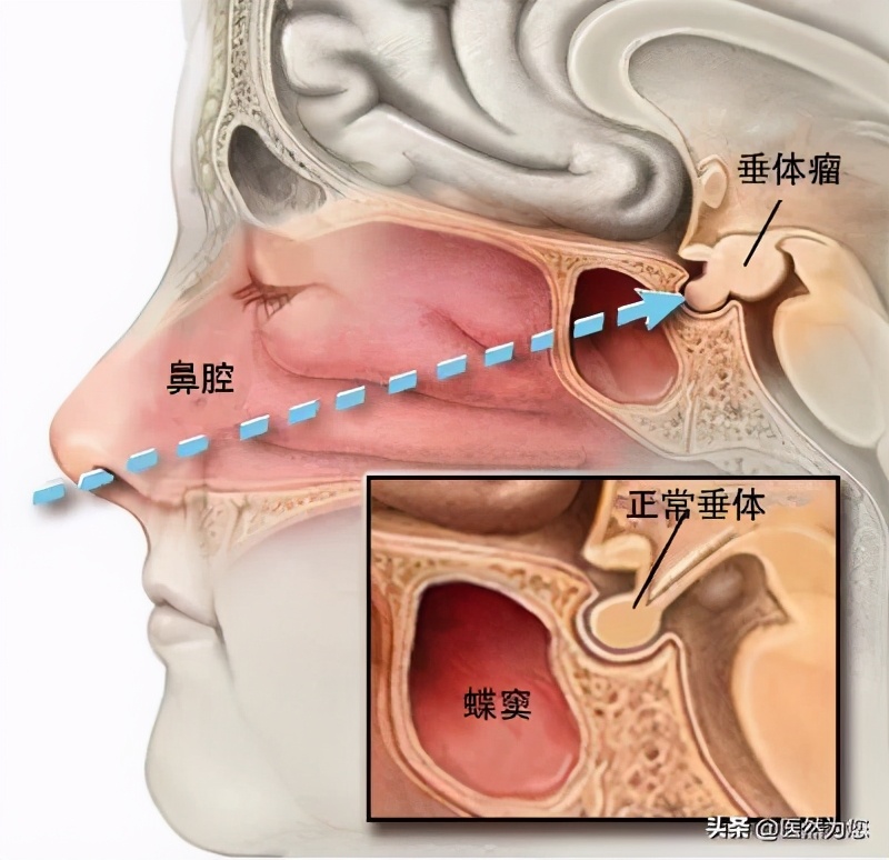 甲亢会老得快吗,吃甲亢药脖子为什么会变大