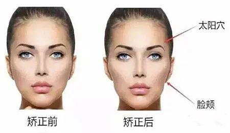 牙套脸怎么恢复原来脸型,整牙齿的牙套脸可以恢复吗