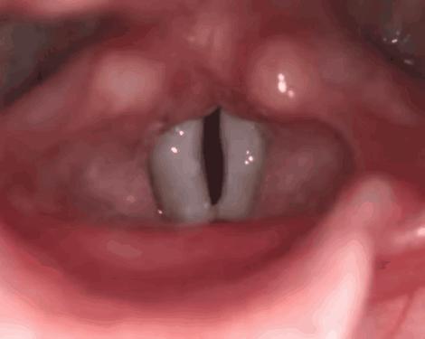 别大意！娃嗓子哭哑了，这种情况可能要手术