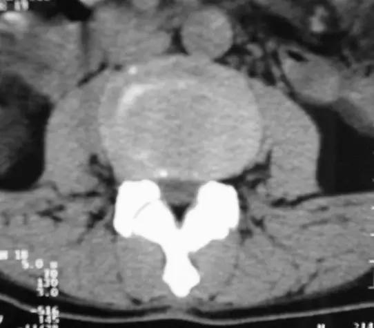 颈椎腰椎疾病ct及mri诊断,腰椎ct可以发现肠部病变吗