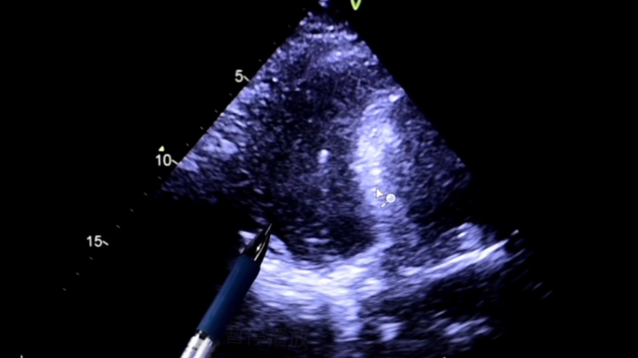 心脏旁边一抽一抽的发紧,心脏扎进一根针能恢复吗