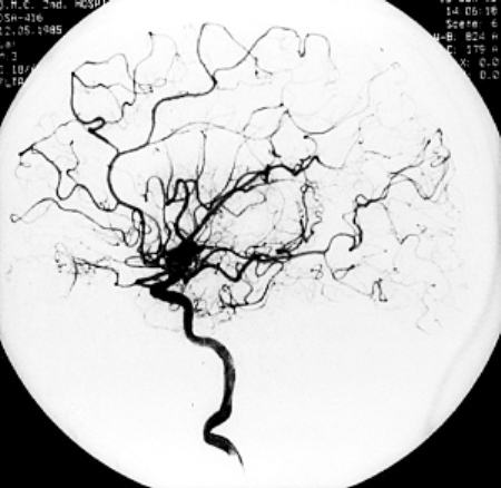 造影剂恶心持续多久,造影后造影剂没有及时排出后遗症