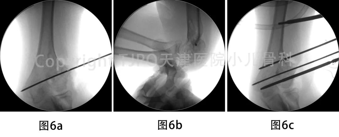 肱骨髁上骨折如何预防肘外翻畸形,肱骨髁上骨折外翻畸形原因