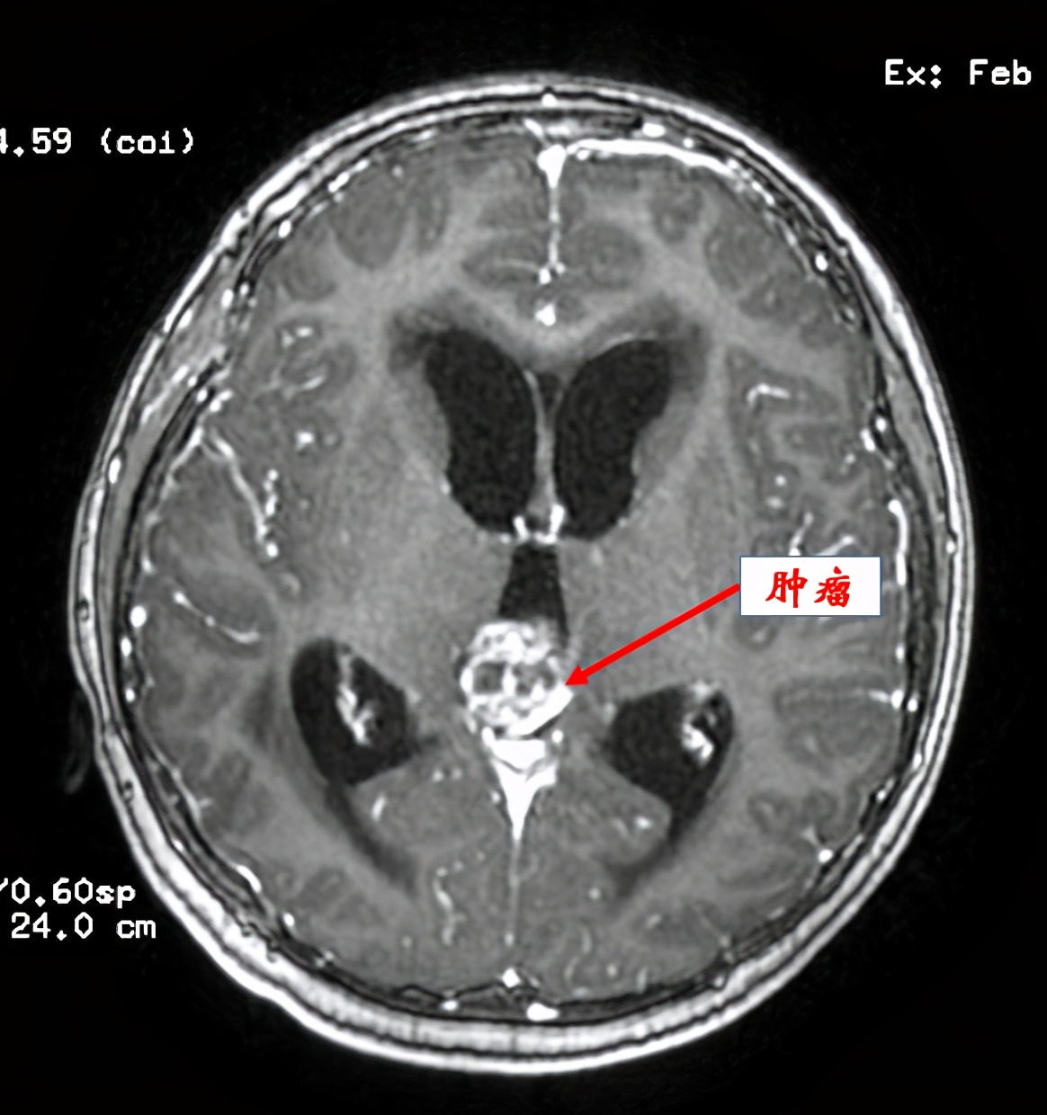 13岁孩子玩手机游戏患脑梗,12岁小男孩玩游戏猝死事件