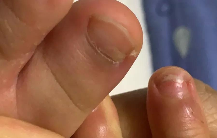 宝宝指甲有白斑倒刺缺什么元素,孩子指甲出白点是缺钙吗