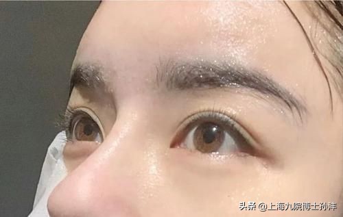 眼整形失败修复要注意哪些问题,想要眼睛大该怎么做