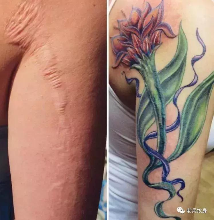 疤痕体质可以用纹身去遮盖疤痕吗,你的疤痕是什么颜色呢