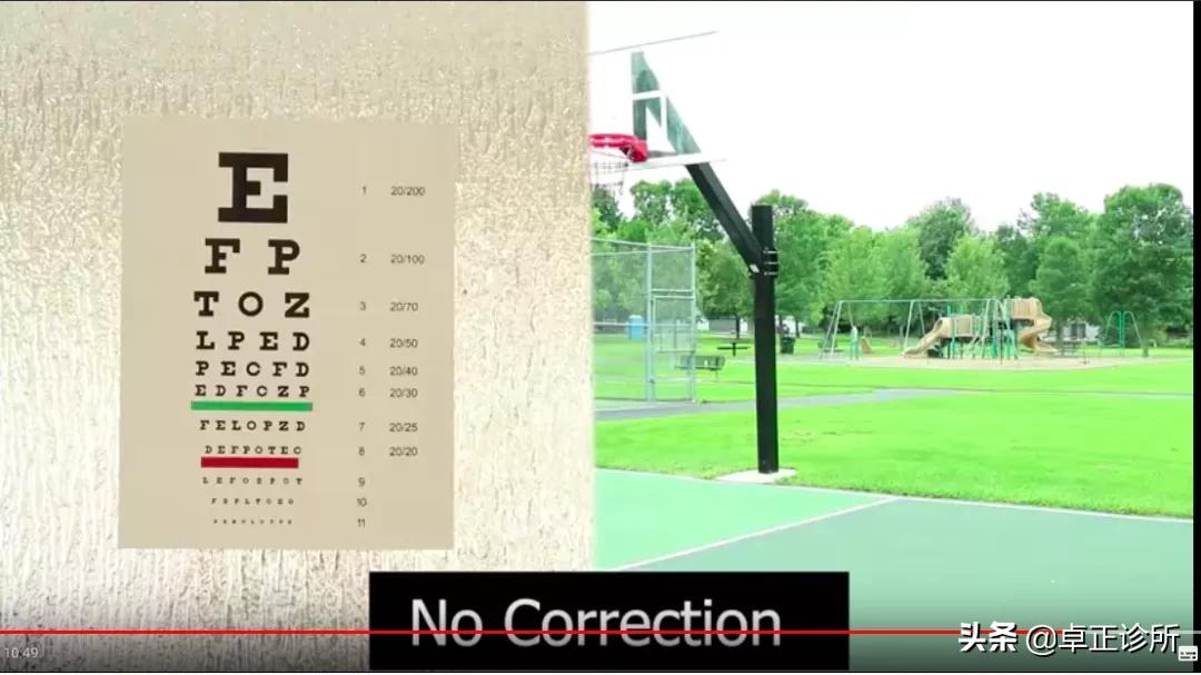 小孩眼睛近视散光怎么改善,眼睛散光近视要怎么改善