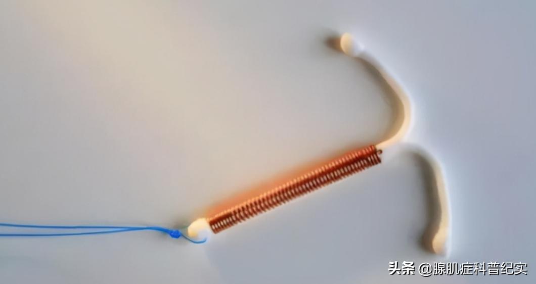 取下节育环会不会减轻腺肌症疼呢,宫内节育环可以治痛经吗